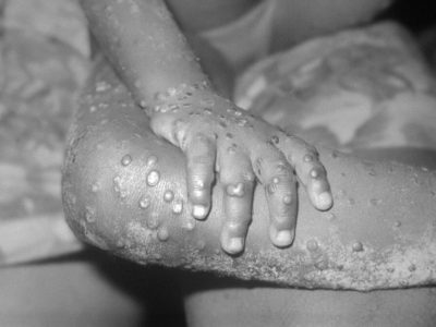 RDC : Kinshasa se dit inquiète de l’épidémie de Monkeypox qui a fait 192 morts selon un dernier bilan