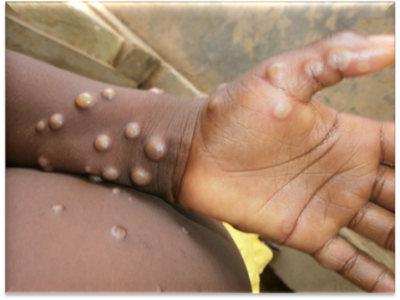Mpox (monkeypox)