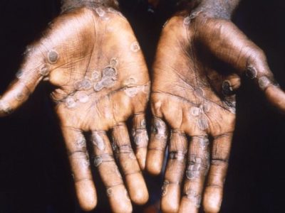 Africa CDC and WHO Update Mpox Strategy as Outbreaks Persist