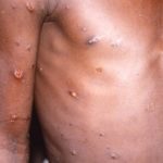 RDC : Une épidémie de Mpox sans précédent et premiers cas signalés en République du Congo