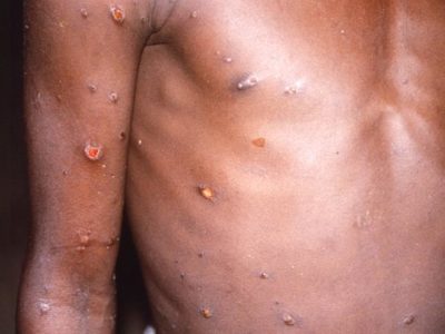 DR Congo mpox outbreak expands, becomes deadlier