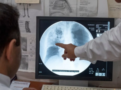 Recrudescence de la tuberculose en tant que principale cause de mortalité imputable à une maladie infectieuse